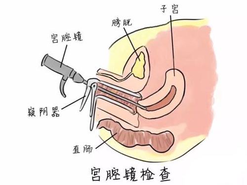 宫外孕手术位置图片图片